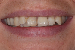 Przypadek 5.
Pacjentka zgłosiła się w celu poprawy estetyki zebów przednich. Problem był związany ze stłoczeniem zębów, Pacjentka skarżyła się
że zęby są nierówne. Dodatkowo zęby zawierały stare wypełnienia, które były przebarwione i nieestetyczne. Zaproponowano
leczenie ortodontyczne, ale zostało ono odrzucone przez Pacjentkę ze względu na stały pobyt za granicą.