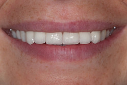 Przypadek 5.
Wykonano na zębach przednich korony porcelanowe na podbudowie z cyrkonu, uzyskano dzięki temu "proste" zęby i estetyczny uśmiech.