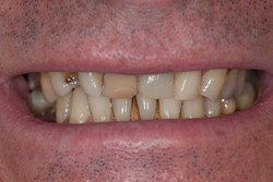 Przypadek 6.
Pacjent zgłosił się w celu poprawy estetyki zębów przednich oraz w celu uzupełnienia brakujących zębów w odcinku bocznym.