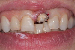 Przypadek 7.
Pacjentka zgłosiła się do gabinetu z powodu złamania korony "jedynki". Ząb wcześniej leczony kanałowo. Doraźnie wykonano
koronę tymczasową i powtórnie przeleczono ząb kanałowo.