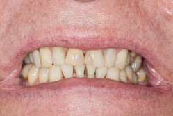 Przypadek 8.
U pacjenta problem estetyczny stanowiły liczne przebarwienia zębów, stare przebarwione wypełnienia, duże stracie zębów obniżona
wysokość zwarcia skutkująca dolegliwościami ze strony stawów skroniowo-żuchwowych.