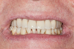 Przypadek 8.
Na zębach górnych przednich wykonano korony porcelanowe, wymieniono stare korony na implantach oraz most w odcinku bocznym.
Na zębach dolnych w odcinku bocznym wykonano onlay'e, a dolne przednie zęby poddano wybielaniu.