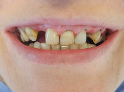 Przypadek 9.
Pacjentka z brakami zębów w odcinku przednim oraz bocznym. Dodatkowy problem stanowiły przebarwione zęby przednie raz stare
wypełnienia. Pacjentka chciała uzupełnić brakujące zęby oraz poprawić kształt i kolor zębów, a nie chciała wykorzystać leczenia
implanto-protetycznego.
