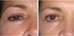 Plexr - zabiegi poprawiające wygląd skóry przed i po zabiegu